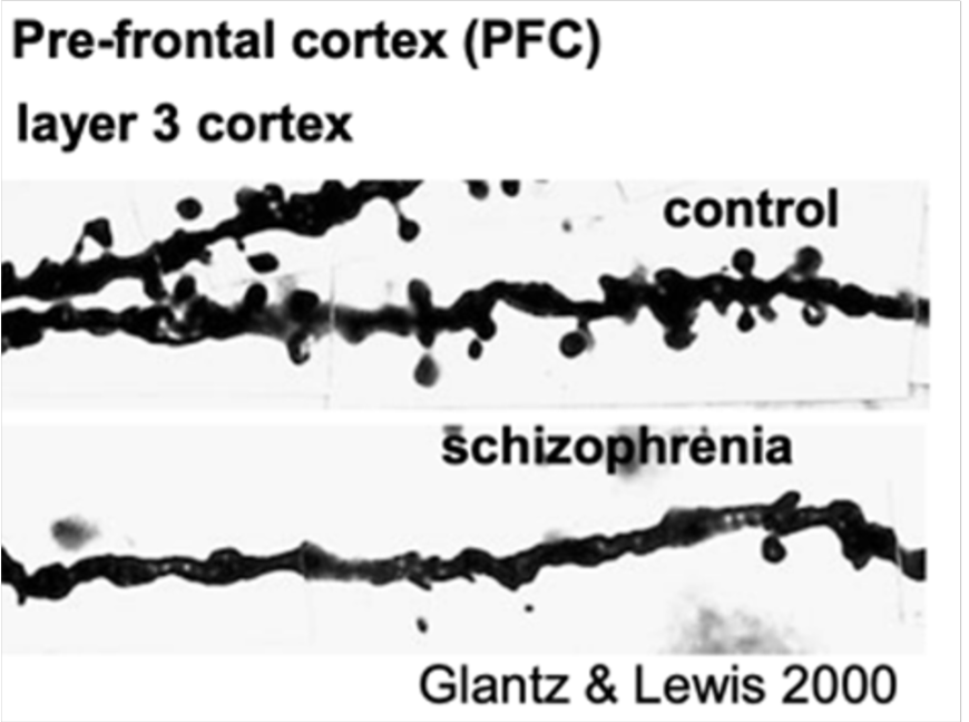 Figure 1: Image showing fewer dendritic spines on cortical neurons in the brains of SCZ patients when compared to healthy controls