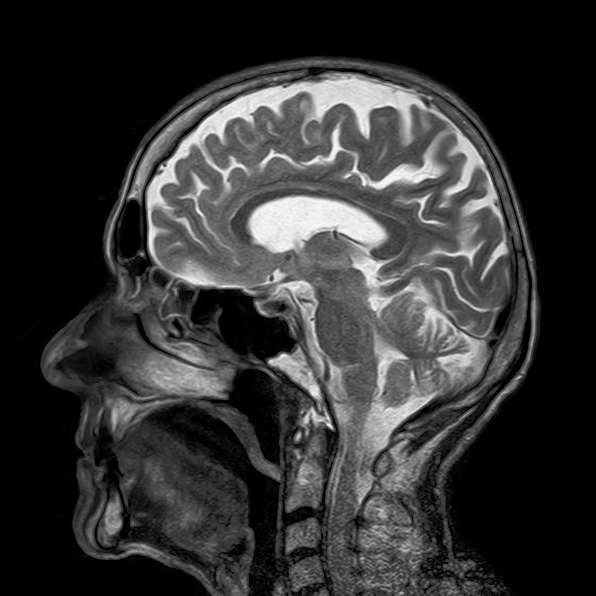 MRI brain