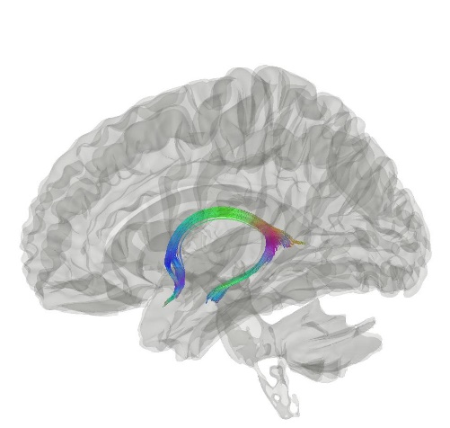 Image of brain with fornix highlighted
